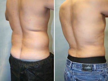 liposuction fresno