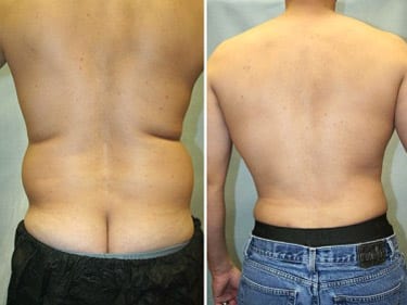 Liposuction