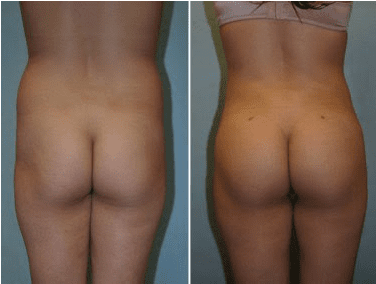Butt augmentation before and after