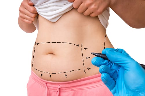 What to Know About Tummy Tuck Recovery - Fresno, CA