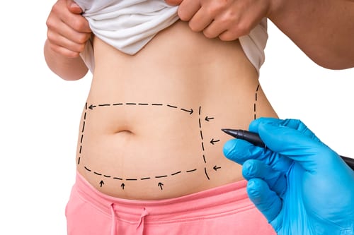 Tummy Tuck Surgery Recovery  Tummy Tuck Surgery Specialist