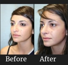 rhinoplasty-01b-blog