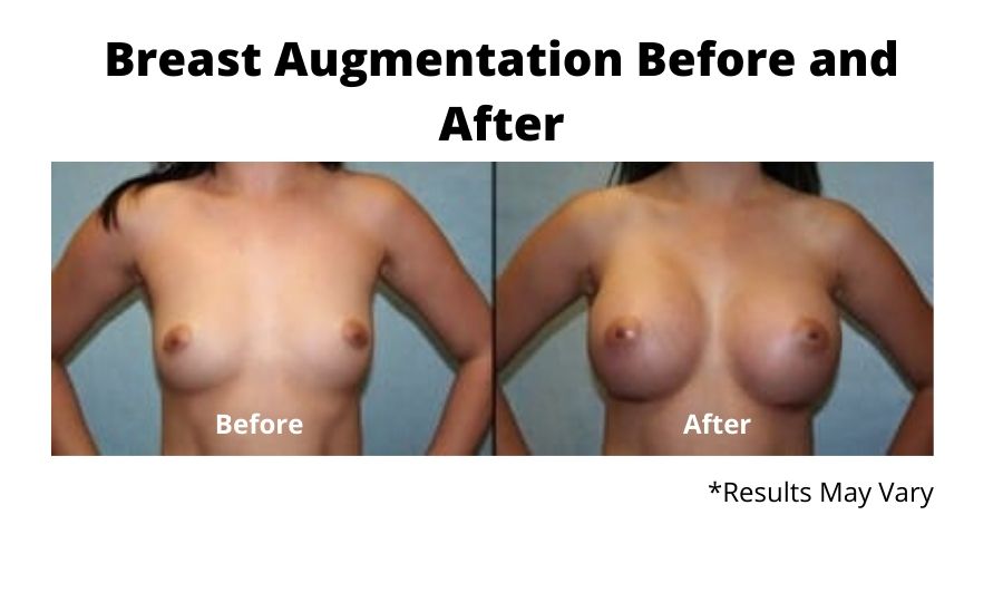 Before and after image showing the results of a breast augmentation performed in Fresno, CA.