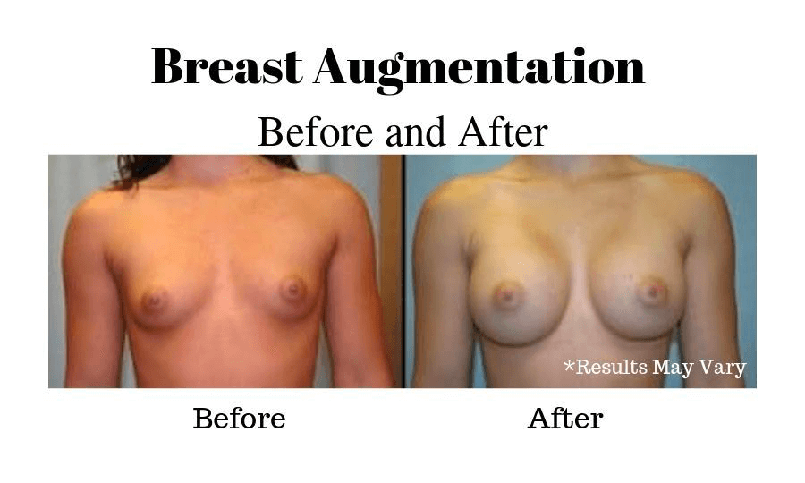 Before and after image showing results of a breast augmentation performed in Fresno, CA.