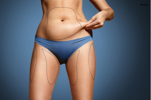 woman pinched her fat on body. Body with marked zones for liposuction-img-blog
