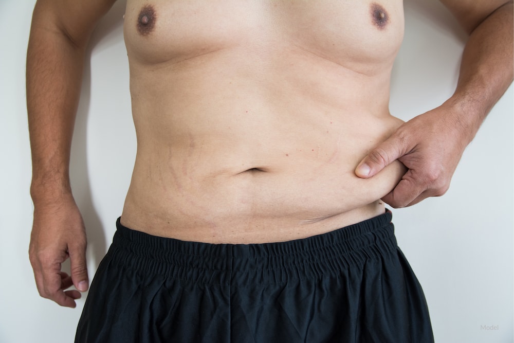 Man pinching excess abdominal skin that could be removed with tummy tuck surgery.