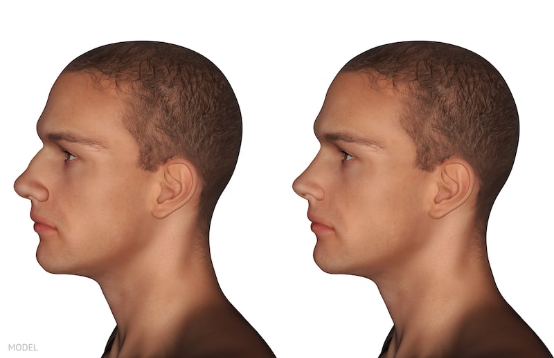 How Can Vectra® 3D Images Improve My Plastic Surgery Results?