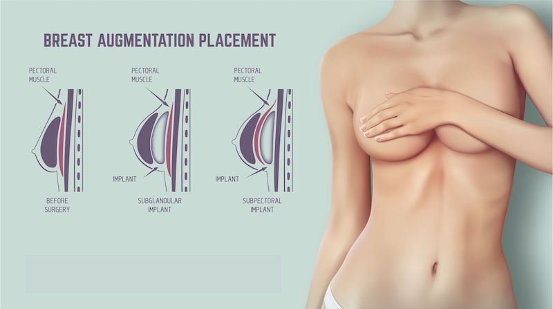 breast implant placement diagram with a woman covering her breasts.
