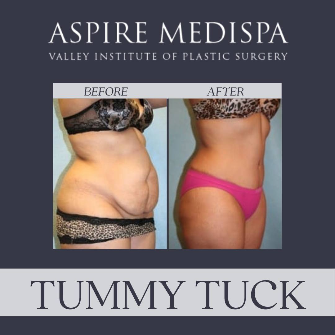 Before and After Tumy Tuck Procedure