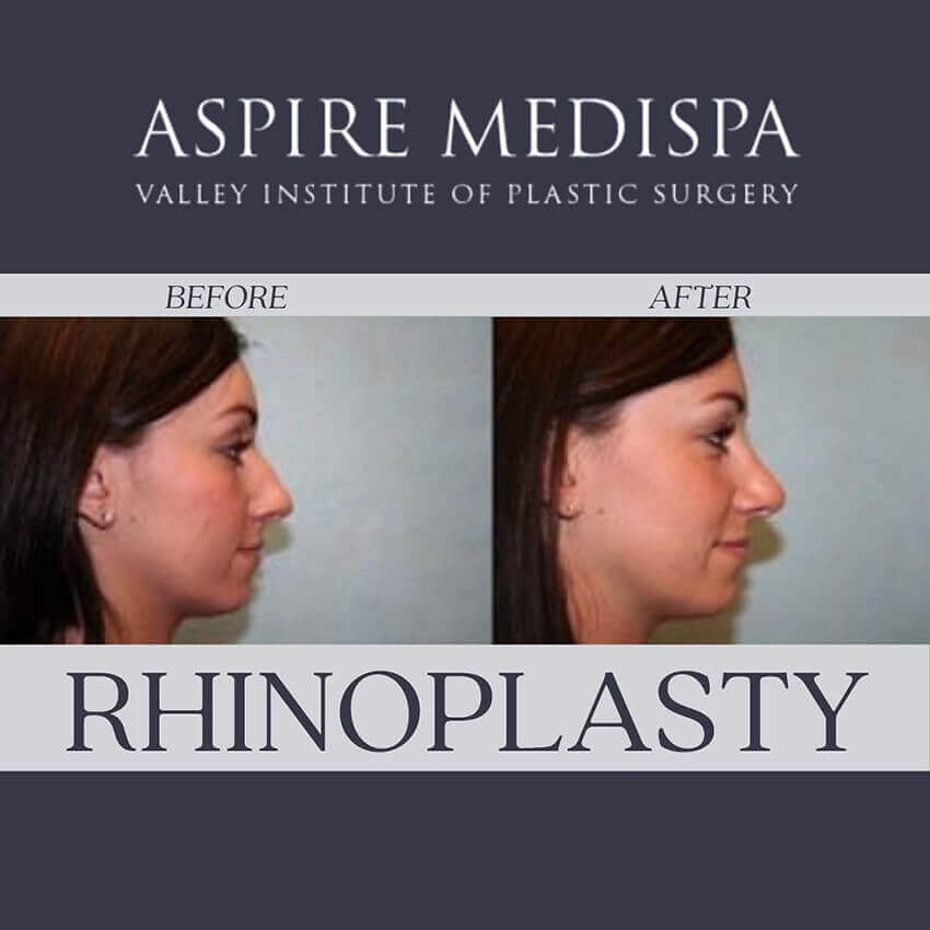 Rhinoplasty Results Instagram Post
