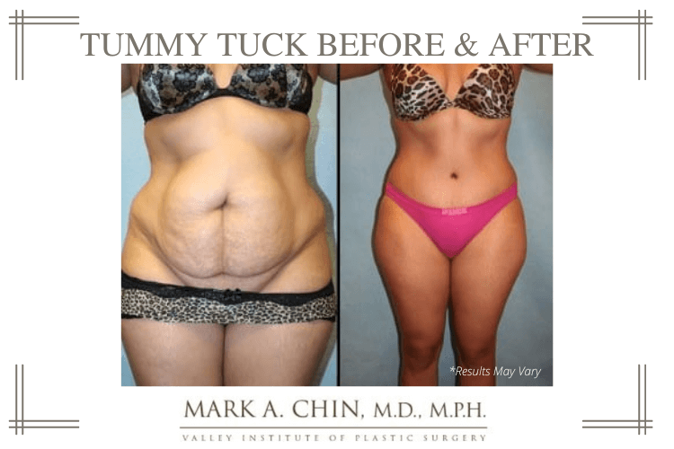 Before and after image showing the results of a tummy tuck performed in Fresno, CA.