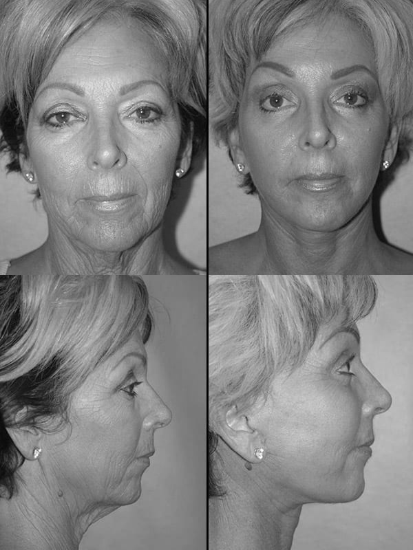 Facelift actual patient results