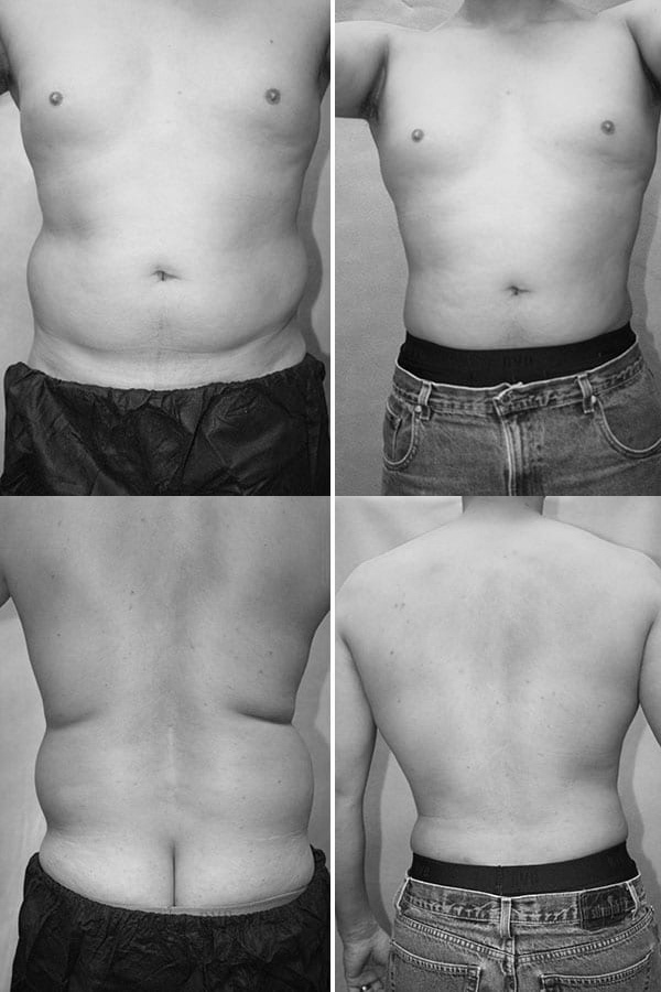Liposuction patient results