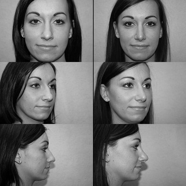 Rhinoplasty Actual Patient Results