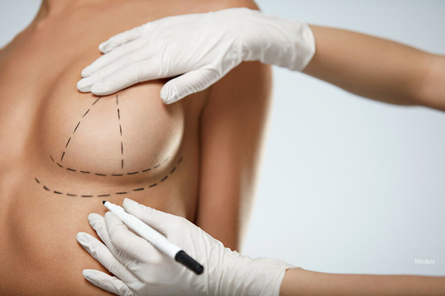 Close up image of doctor drawing lines on woman's breast for breast surgery