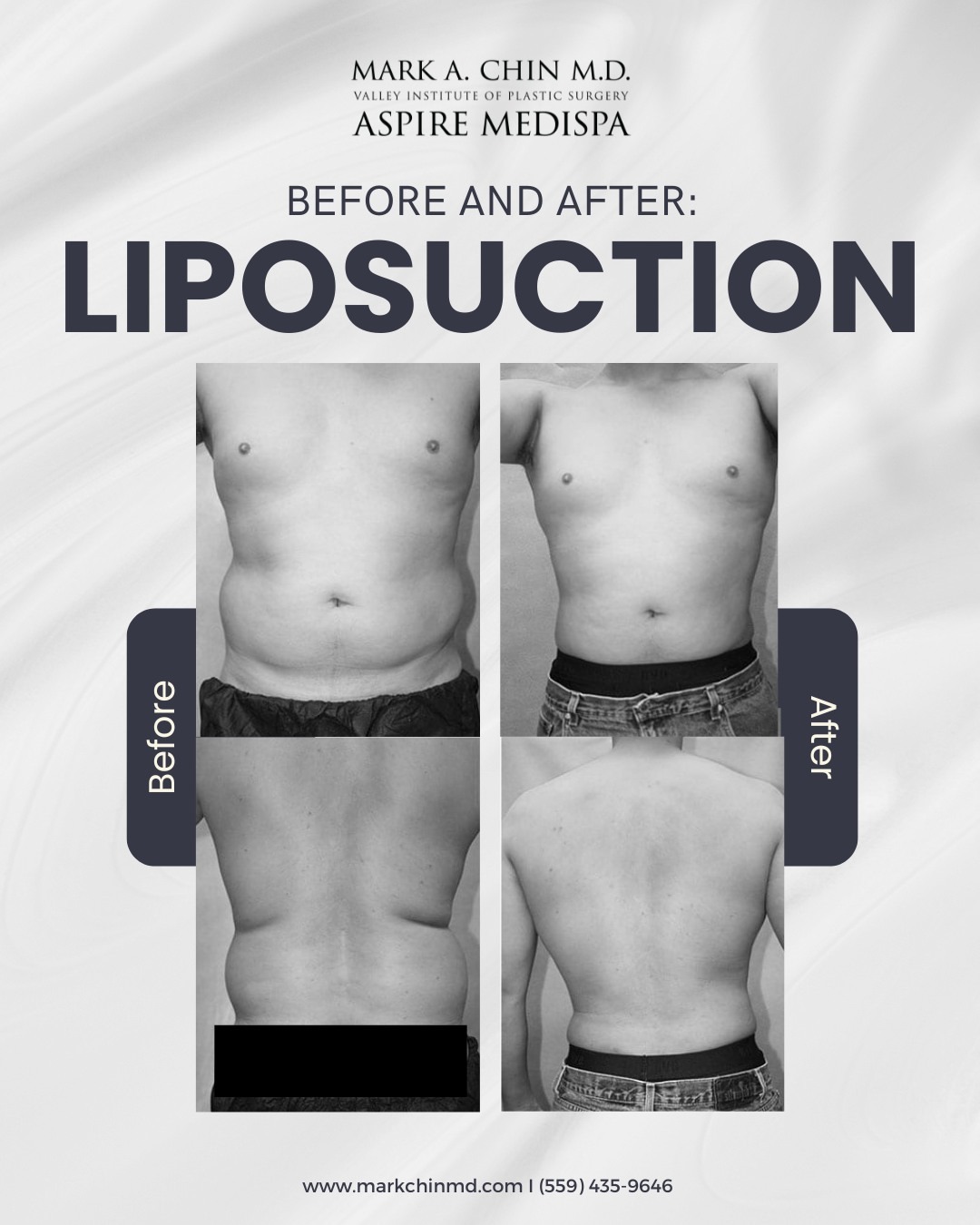 Liposuction Before and After