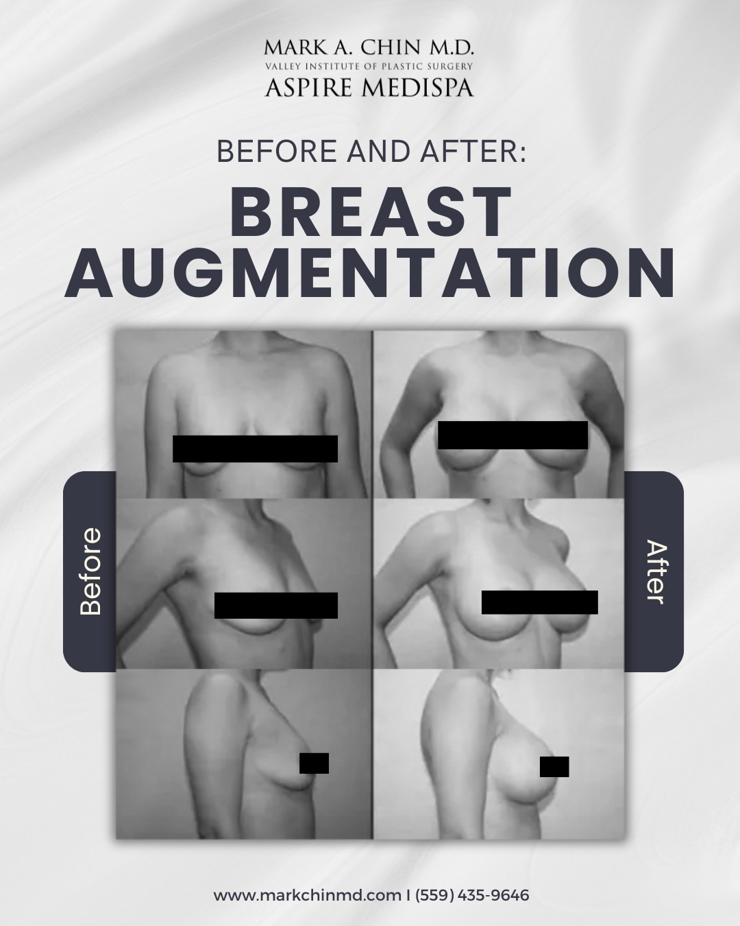 Breast Augmentation Before and After